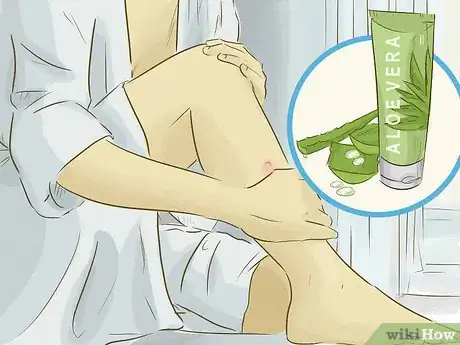 Image titled Get Rid of Keloids Step 1