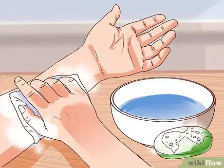 Image titled Treat a Human Bite Step 4