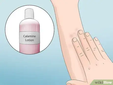 Image titled Treat Infected Insect Bites at Home Step 5