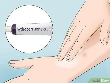 Image titled Treat Infected Insect Bites at Home Step 3