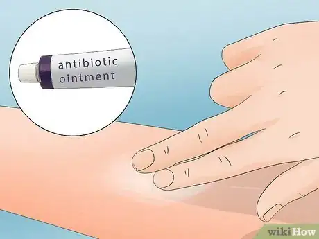 Image titled Get a Tick Head Out Step 6