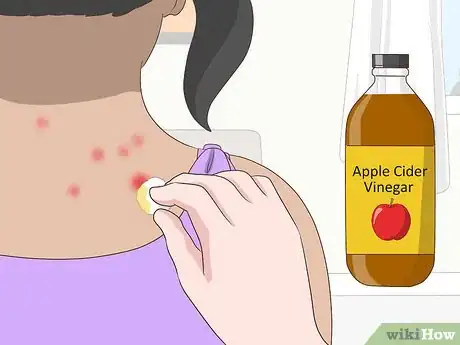 Image titled Stop Gnat Bites from Itching Step 4