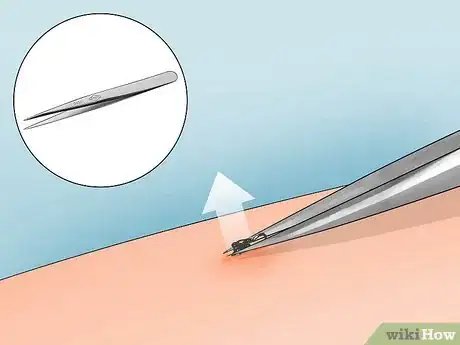 Image titled Get a Tick Head Out Step 1