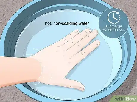 Image titled Treat a Lionfish Sting Step 6