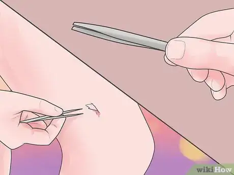 Image titled Remove Glass from a Wound Step 1