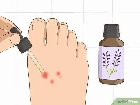 Image titled Stop Gnat Bites from Itching Step 5