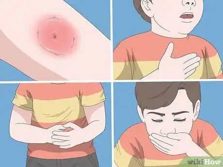 Image titled Treat Spider Bites on Kids Step 2