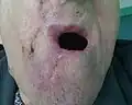 Followup 12 days after 1st surgery