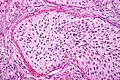 High magnification micrograph of a Brenner tumor showing the characteristic coffee bean nuclei which are also seen in Walthard cell rests. H&E stain.