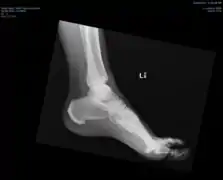 Ectopic calcification and new bone formation in diffuse idiopathic skeletal hyperostosis (DISH)