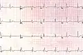 RBBB