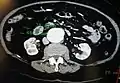 A transverse contrast enhanced CT scan demonstrating an abdominal aortic aneurysm of 4.8 by 3.8&nbsp;cm