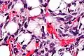 Micrograph showing a lipoblast (left-bottom of image) in a liposarcoma. H&E stain.