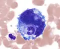 Emperipolesis: a band neutrophil inside a megakaryocyte (Wright-Giemsa, 100x, oil).