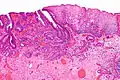 Micrograph showing histopathological appearance of an esophageal adenocarcinoma (dark blue – upper-left of image) and normal squamous epithelium (upper-right of image) at H&E staining