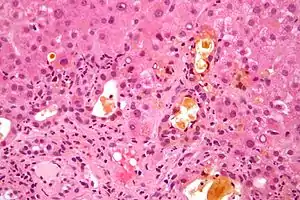 Feathery degeneration. H&E stain.