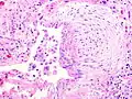 A fibroblast focus in a surgical lung biopsy of UIP. Hematoxylin-eosin stain, high magnification. The white space to the left is an airspace. The pale area to the right is a fibroblast focus. It is an area of active fibroblast proliferation within the interstitium of the lung.