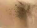 A. nigricans, right armpit; notice the skin tags, an indicator for levated blood sugar and hyperinsulinaemia