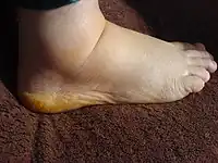Foot two weeks post-surgery