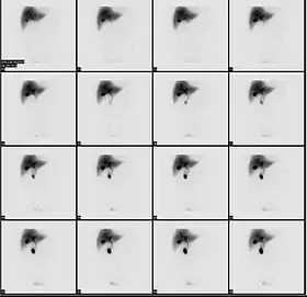 Normal hepatobiliary scan (HIDA scan). The nuclear medicine hepatobiliary scan is clinically useful in the detection of the gallbladder disease.