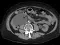 Massive hydronephrosis as marked by the arrow.