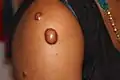 Keloid nodules (1–2&nbsp;cm in diameter) and a keloid tumor >2&nbsp;cm. in diameter