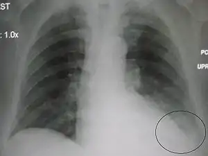 AP CXR showing left lower lobe pneumonia associated with a small left sided pleural effusion