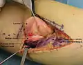 Intraoperative photo