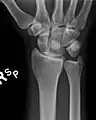 Dislocated lunate