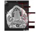 Horizontal MRI scan of a head, at the level of the maxillary teeth, showing the masseter muscle and neighbors.