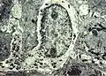 Melanocyte with melanin granules in dendrite. .mw-parser-output cite.citation{font-style:inherit;word-wrap:break-word}.mw-parser-output .citation q{quotes:"\"""\"""'""'"}.mw-parser-output .citation:target{background-color:rgba(0,127,255,0.133)}.mw-parser-output .id-lock-free a,.mw-parser-output .citation .cs1-lock-free a{background:url("//upload.wikimedia.org/wikipedia/commons/6/65/Lock-green.svg")right 0.1em center/9px no-repeat}.mw-parser-output .id-lock-limited a,.mw-parser-output .id-lock-registration a,.mw-parser-output .citation .cs1-lock-limited a,.mw-parser-output .citation .cs1-lock-registration a{background:url("//upload.wikimedia.org/wikipedia/commons/d/d6/Lock-gray-alt-2.svg")right 0.1em center/9px no-repeat}.mw-parser-output .id-lock-subscription a,.mw-parser-output .citation .cs1-lock-subscription a{background:url("//upload.wikimedia.org/wikipedia/commons/a/aa/Lock-red-alt-2.svg")right 0.1em center/9px no-repeat}.mw-parser-output .cs1-ws-icon a{background:url("//upload.wikimedia.org/wikipedia/commons/4/4c/Wikisource-logo.svg")right 0.1em center/12px no-repeat}.mw-parser-output .cs1-code{color:inherit;background:inherit;border:none;padding:inherit}.mw-parser-output .cs1-hidden-error{display:none;color:#d33}.mw-parser-output .cs1-visible-error{color:#d33}.mw-parser-output .cs1-maint{display:none;color:#3a3;margin-left:0.3em}.mw-parser-output .cs1-format{font-size:95%}.mw-parser-output .cs1-kern-left{padding-left:0.2em}.mw-parser-output .cs1-kern-right{padding-right:0.2em}.mw-parser-output .citation .mw-selflink{font-weight:inherit}PMID&nbsp;6200593