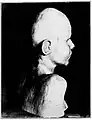 Microcephaly (microbrachycephaly)
