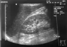 Ultrasound of liver (left side of the image) and right kidney (right side of the image) and Morison's pouch, not containing fluid.