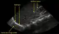 A normal ultrasonographic view of Morison's pouch.  The bright line is the capsule of the kidney; there is no fluid present and hence no visible space.