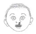 Nasomaxillary dysplasia