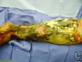 Necrotizing fasciitis type III caused by vibrio vulnificus.
