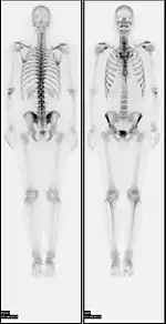 A nuclear medicine whole body bone scan. The nuclear medicine whole body bone scan is generally used in evaluations of various bone-related pathology, such as for bone pain, stress fracture, nonmalignant bone lesions, bone infections, or the spread of cancer to the bone.