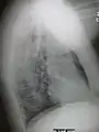 Normal lateral CXR