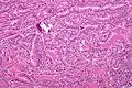 Micrograph of papillary thyroid carcinoma, tall cell variant - intermediate magnification. H&E stain.