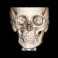 CT scan3D bone reconstruction of a 17-year-old girl with Parry Romberg syndrome.