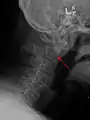 A fracture of the base of the dens as seen on plain X-ray