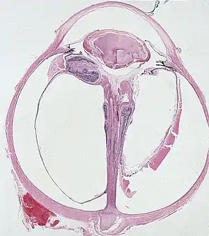 This term emphasizes the etiology of the disorder, incorporates the full extent of the disease, and offers a better description of the various clinical manifestations associated with the failure of fetal vasculature regression.