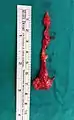 Pilonidal disease removed