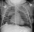 Pneumomediastinum with angel wing sign