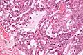 Micrograph of a polymorphous low-grade adenocarcinoma. H&E stain.