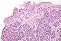 Micrograph of a Sertoli cell nodule. H&E stain.