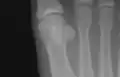 Sesamoid bones at the distal end of the first metatarsal.