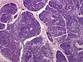 Dermal cylindroma. Hyaline droplets visible in lobules.