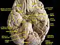 Cerebrum.Inferior view.Deep dissection.