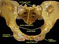 Anterior view of the body pelvis from a dissection. Pubic symphysis anteriorly.